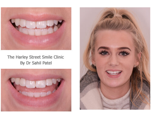 Tooth Contouring 01