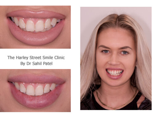 Tooth Contouring 02