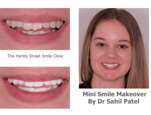 Mini Smile Makeover 04