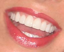 Jill's Teeth - Harley St Smile