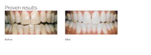Teeth Whitening Before and After - Harley St Smile