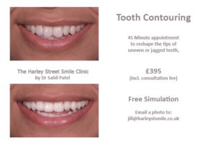 Tooth Contouring Harley St Smile
